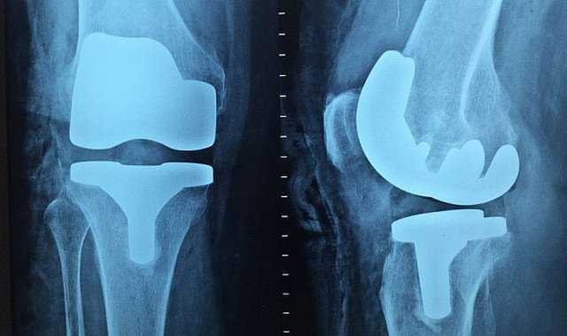 В России запущена инновационная методика восстановления коленного сустава