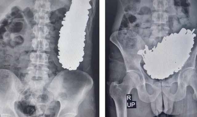 В Иране врачи обнаружили в желудке мужчины 452 металлических предмета